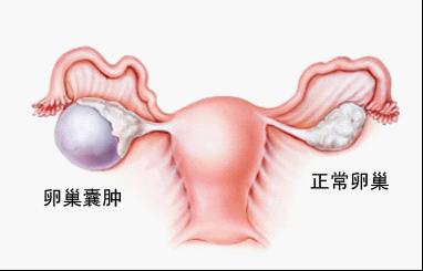 <b>关于卵巢囊肿的早期症状</b>