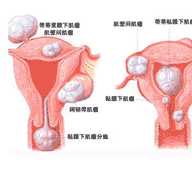 子宫肌瘤