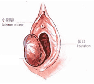 前庭大腺囊肿